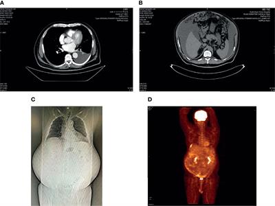 Challenging Diagnostic Process for a Malignant Peritoneal Mesothelioma Patient With Ascites and Pleural Effusion: A Case Report and Review of the Literature